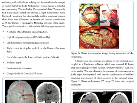 Acute Spontaneous Cerebral Hemorrhage in the Subdural Space - Clinical Case