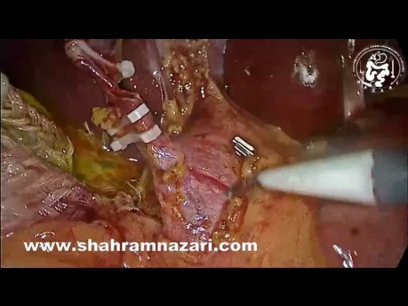 Laparoscopic CBD Exploration, Antegrade Sphincterotomy, CBD Stent