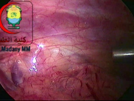Laparoscopic Right Congenital Hernia for 4 Years Old Boy