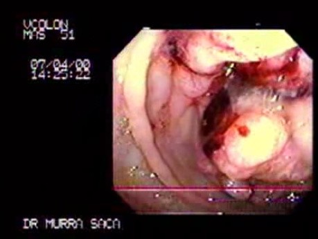 Endoscopic Image of Adenocarcinoma Of The Cecum