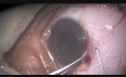 Removal of a Compound Naevus of Conjunctiva