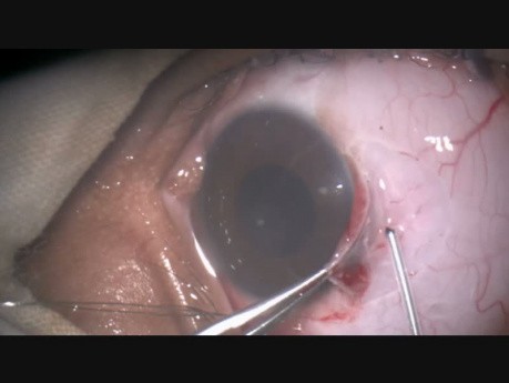 Removal of a Compound Naevus of Conjunctiva