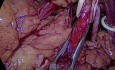 Laparoscopic Partial Nephrectomy
