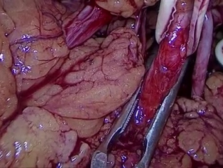 Laparoscopic Partial Nephrectomy
