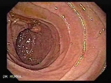Duodenal Lymphangiectasia (2 of 5)