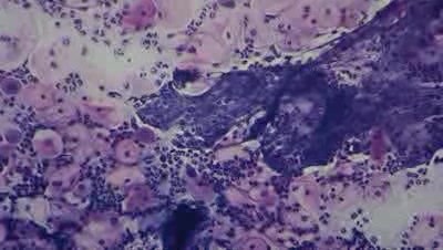 Cervicitis - Fibrin