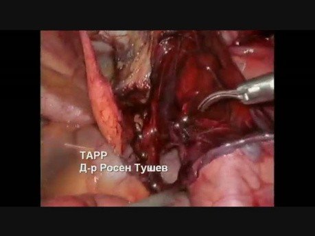 Right Inguinal Hernia Repair - TAPP