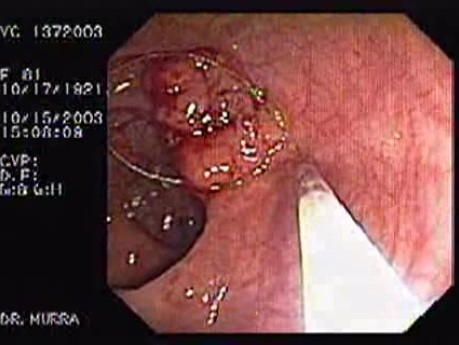 Tubulo - Villous Adenoma - Endoscopy (20 of 28)
