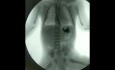 Esophageal Atresia with Distal Tracheoesophageal Fistula