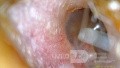 Dermoid Cyst - Comments?
