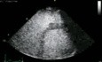 Right Ventriculus Study