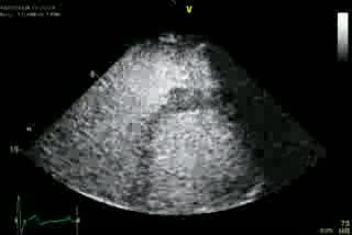 Right Ventriculus Study
