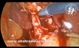 Laparoscopic Cholecystostomy in Acute Gangrenous Cholecystitis