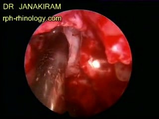 Frontal Sinusitis