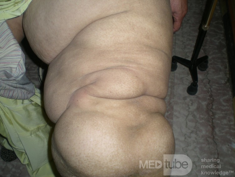 Leg Swelling