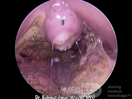 Secondary Infection of Post-Tonsillectomy Bed