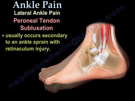 Ankle Pain - Ligaments, Sprain - Video Lecture
