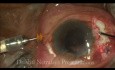 Comprehensive Management of Ectopia Lentis by Phacofragmentation and Scleral Tuck Lens