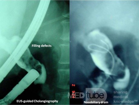 EUS-guided Biliary Drainage