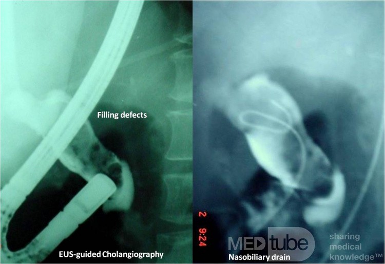 EUS-guided Biliary Drainage