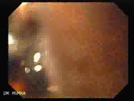 Adenocarcinoma of the Antrum (2 of 5)