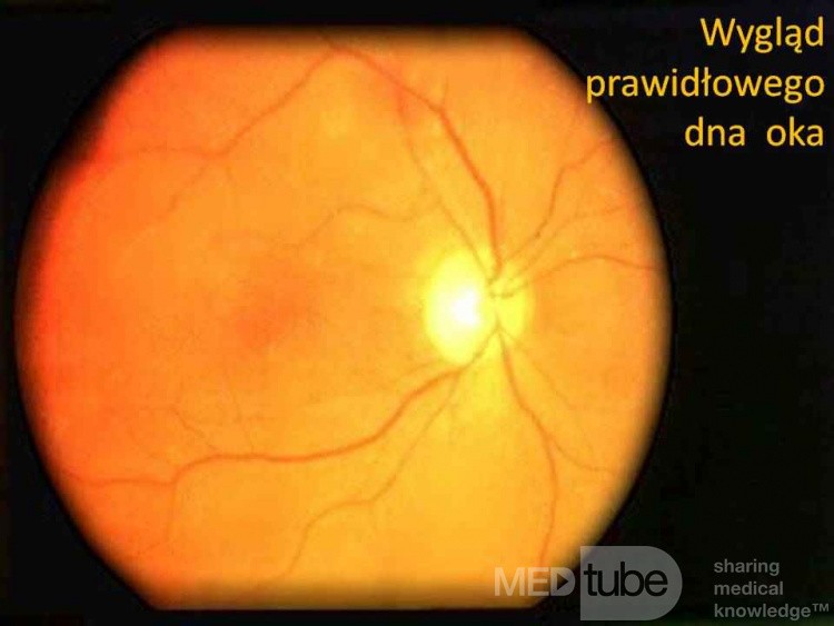 Normal Fundus Of The Right Eye