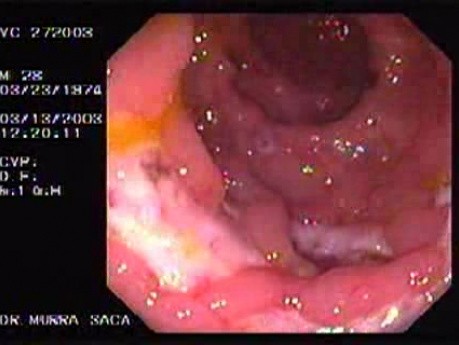 Familial Adenomatous Polyposis of the Colon (26 of 29)