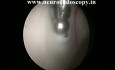 Endoscopic Septostomy