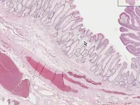 Tubular adenoma (adenomatous polyp) - Histopathology - Colon