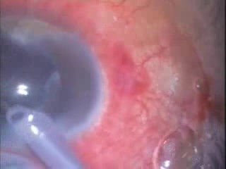 Phacoemulsification - Leaky Bleb During Procedure