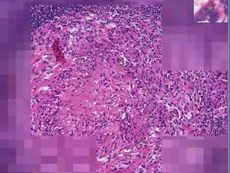 Tuberculosis