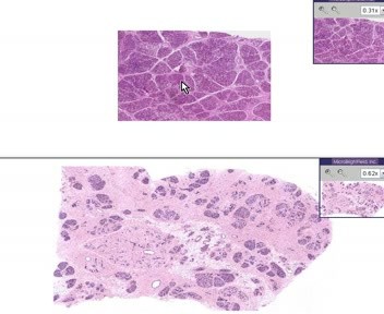 Breast - Hyperplasia Of Lactation