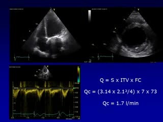 Echocardiographic Measurement Of Cardiac Output