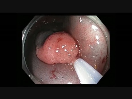 Transverse Colon - Large Flat Lesion - LST-NG - EMR