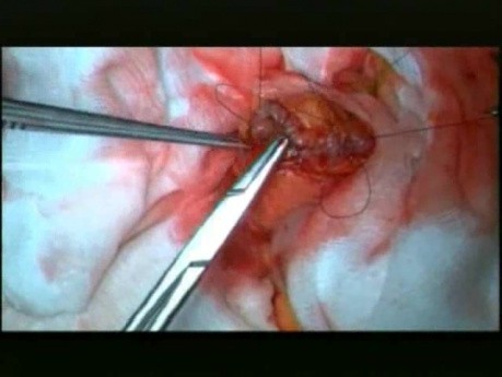 Open Right Hemicolectomy – Technical Principles - Operation No 1 - Part 4