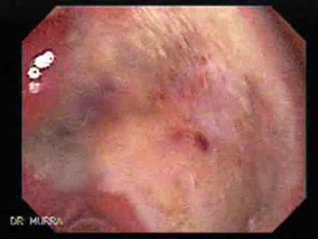 Duodenal Ulcer and Bleeding (13 of 23)