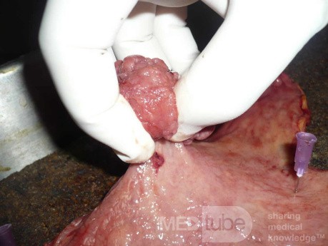 Polypoid Adenocarcinoma (6 of 9)