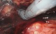 Robotic Retroperitoneal Adrenalectomy for Large Adrenal Lesions Feasibility