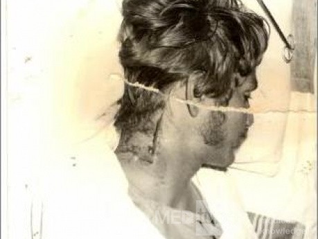 Arrow Injury Of The Neck