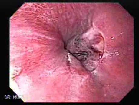 Gastric Varices - Endoscopic Ablation With Cyanoacrylate Glue (15 of 18)
