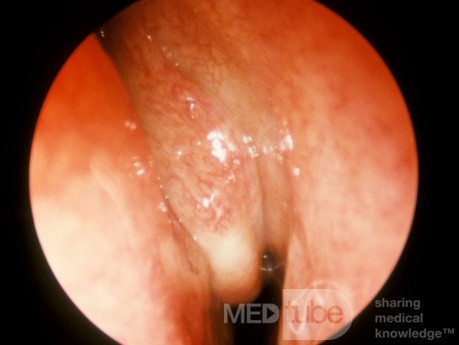 Orbital Cellulitis Secondary To Acute Pansinusitis 2