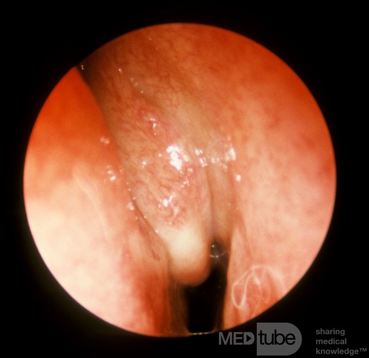 Orbital Cellulitis Secondary To Acute Pansinusitis 2