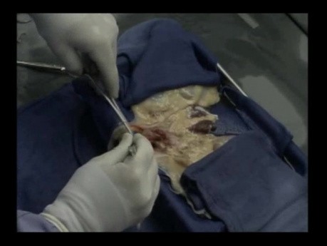 Kidneys Dissection Before Pulsatile Machine Perfusion On Waters Medical Systems With RM3