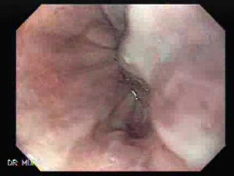 Ligation of Esophageal Varices - Varix with the Ulceration, Part 2
