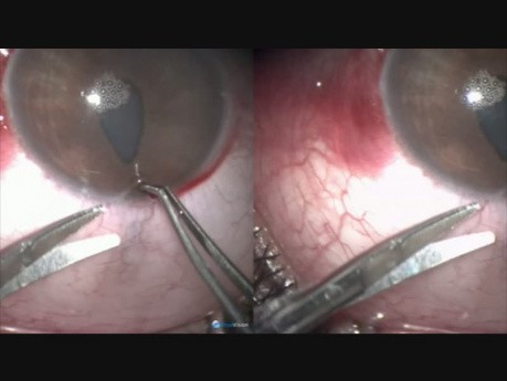 Juvenile Glaucoma - Microtrack Filtration, Follow up of Second Eye