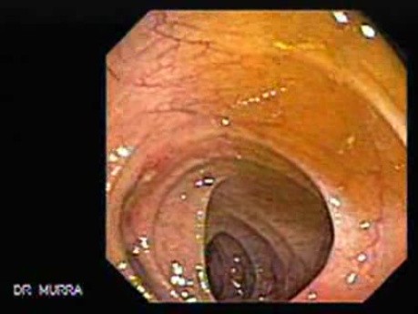 Diverticulitis (3 of 4)