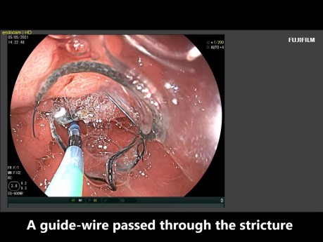 EUS Guided Gastroenterostomy in a Patient with Ascites