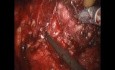 Robotic Prostatectomy in Prostate Cancer Patient - Nerve Sparing