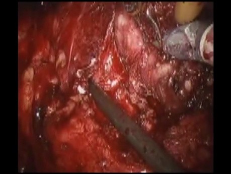 Robotic Prostatectomy in Prostate Cancer Patient - Nerve Sparing