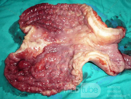 Endoscopy of Scirrhous Gastric Carcinoma involving the entire Fundus, Body and the Antrum (34 of 47)